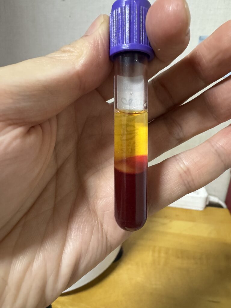 원심분리 완료된 사진 혈장이 분리됨